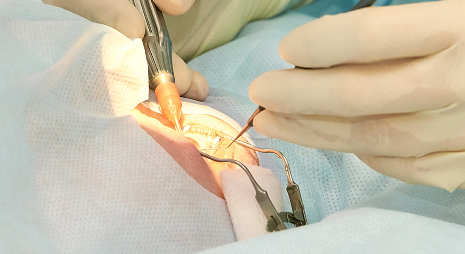 白内障・緑内障など手術