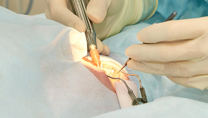 白内障・緑内障など手術